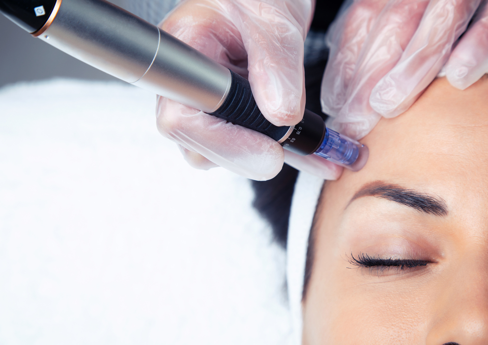 Micro Needling