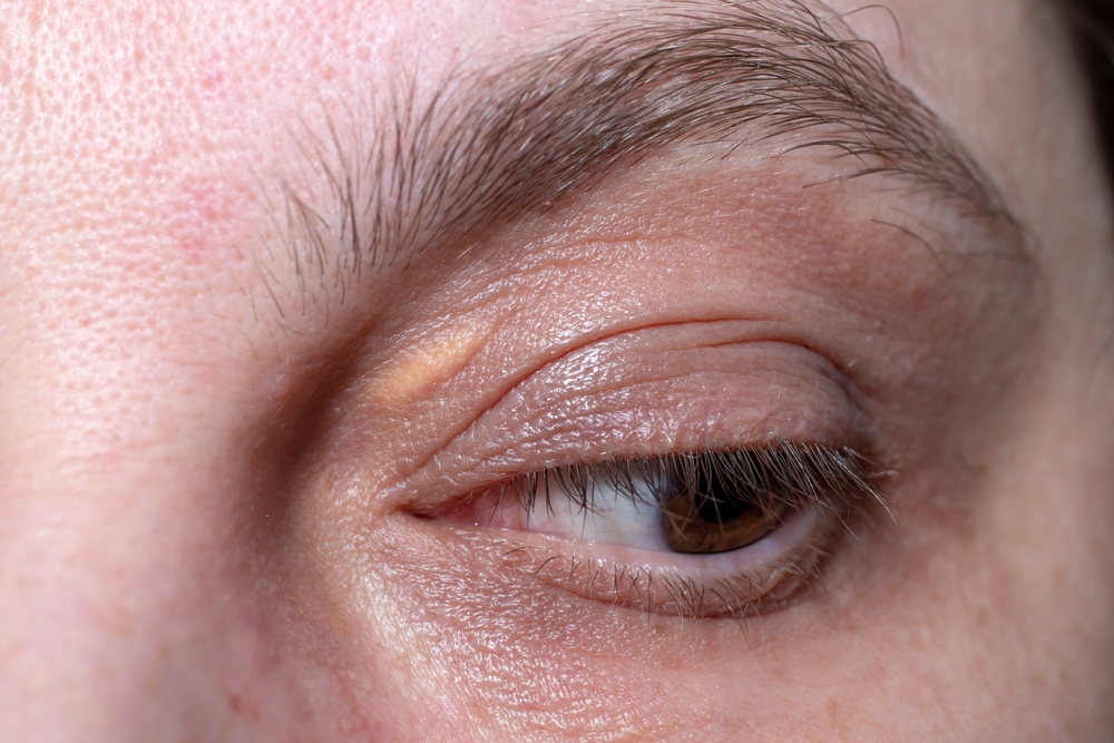 Xantelasma